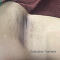 Chicken skin and Ingrown hair on armpits how to treat?